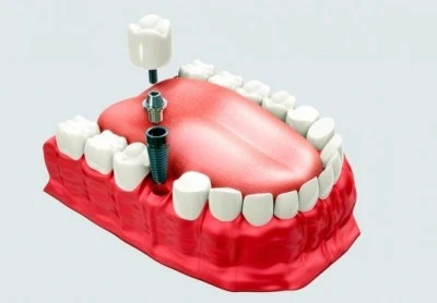 Por que fazer um implante dental unitário?