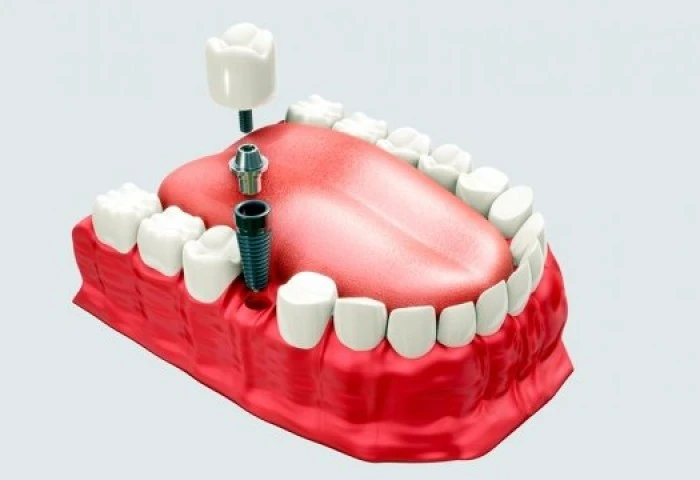 Por que fazer um implante dental unitário?