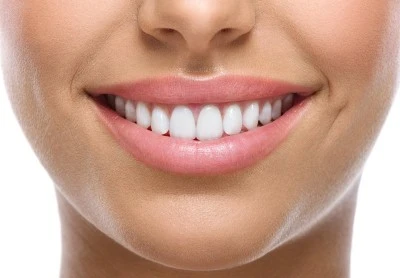 Lente de contato dental: tudo o que você precisa saber sobre esse tratamento