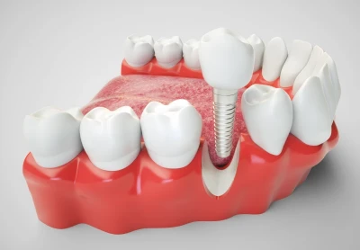 Implante dentário sem dor: entenda como é possível