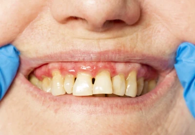 O que é periodontite e como o tratamento periodontal pode ajudar?